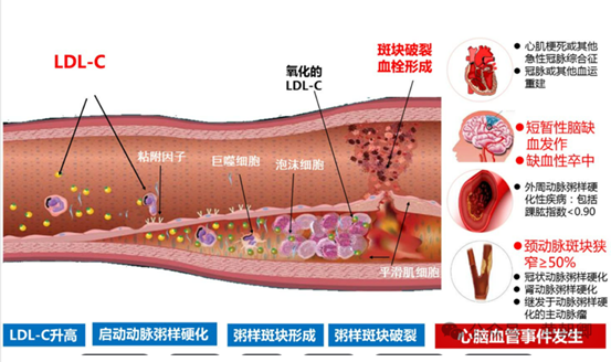 步長青花瓷腦心通膠囊抗動脈硬化穩定斑塊-醫學文獻證實